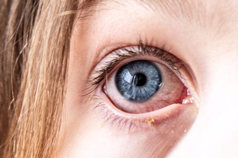 Bindehautentzündung – Rock My Health